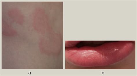 Urticaria and angioedema - Medicine