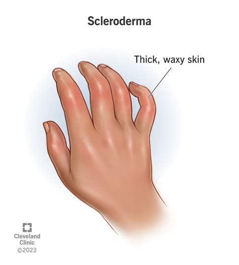 Scleroderma: Symptoms, Causes Treatment Options, 40% OFF