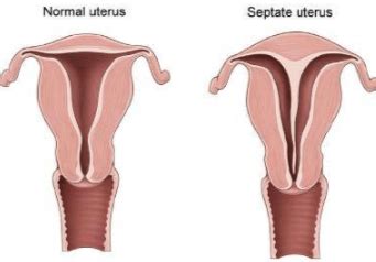 Uterine Septum | Dr Tamara Hunter | Specialist Gynaecologist | Perth