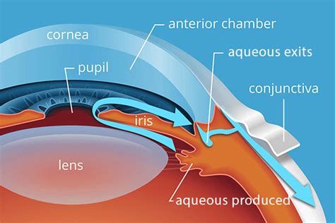 What Causes Glaucoma?