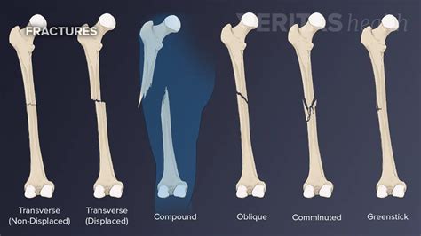 Greenstick Fracture