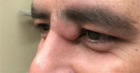 Dr. Pimple Popper Removes Massive Cyst From a Man's Eye Area | Allure