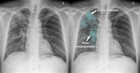 Tuberculosis Lung X Ray