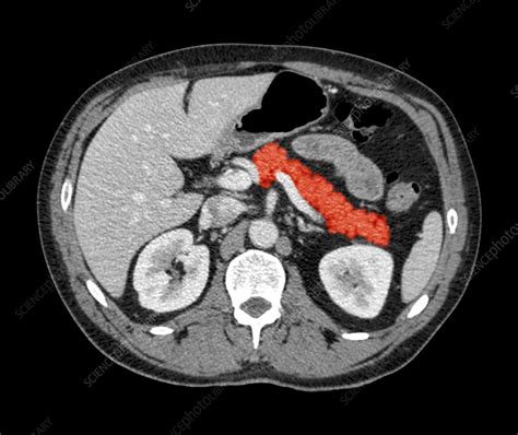 Normal Ct Scan Abdomen