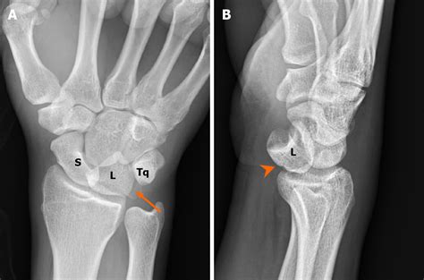 Lunate Dislocation Pie Sign