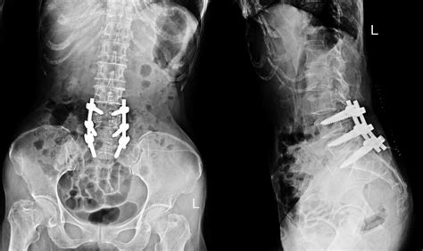 Lumbar Fusion - Neurosurgery of St. Louis | STL Brain & Spine Doctors