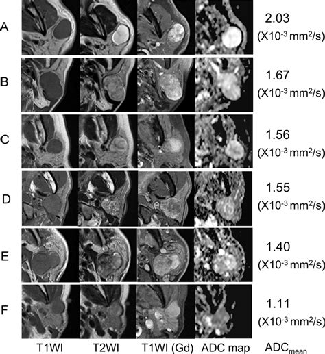 MRI of representative cases with pleomorphic adenoma. Tumors on the ...