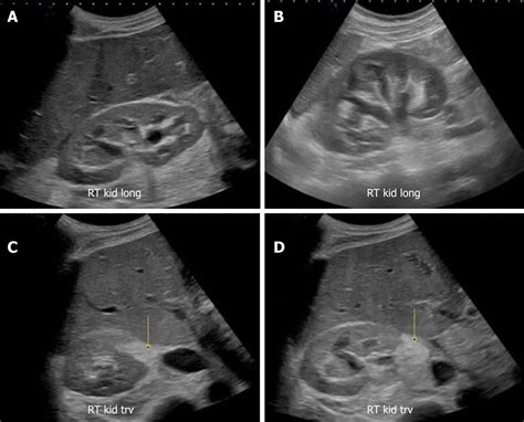 Point of care renal ultrasonography for the busy nephrologist: A ...