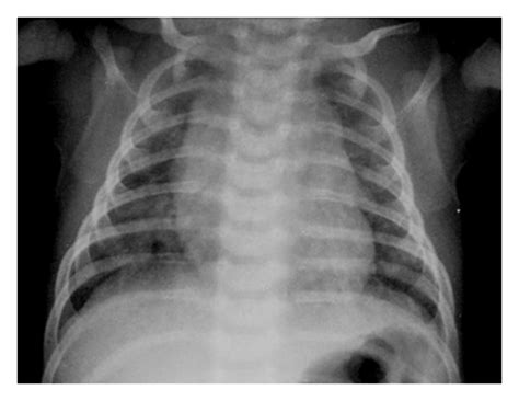 Hyperinflation pattern-chest radiograph showing pulmonary bilateral ...