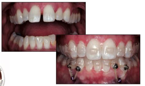 Perfect-A-Smile Aligner Pontic Paint - Orthodontic Supplies Australia