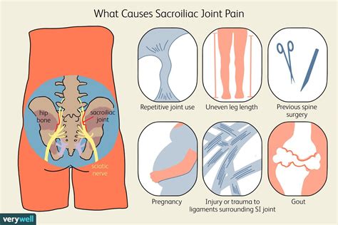 Sacroiliac Joint Pain: Symptoms, Causes, and Treatment