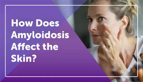 How Does Amyloidosis Affect the Skin? | MyAmyloidosisTeam