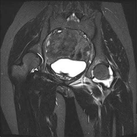 Normal Hip Mri