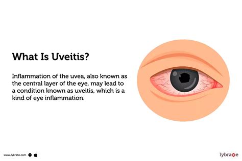 Uveitis: Causes, Symptoms, Treatment and Cost