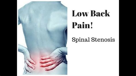 Low Back Pain: Spinal Stenosis - YouTube