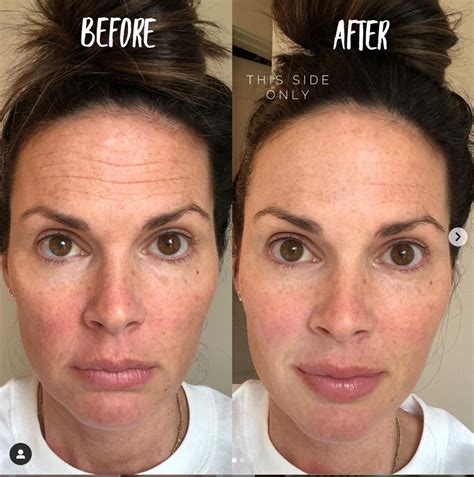 30 Second Eye Miracle. Break Up With Your Botox. | Puffy eyes, Under ...