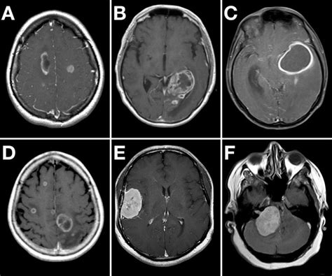 Brain Mri Scan Tumor