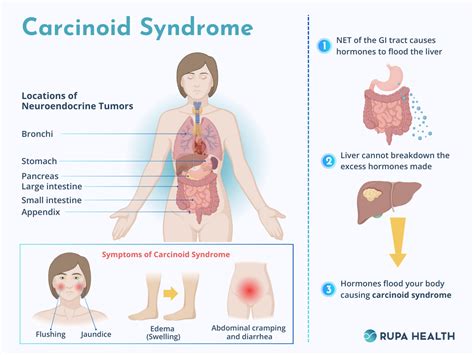 What is Carcinoid Syndrome, and How Can Functional Medicine Help?