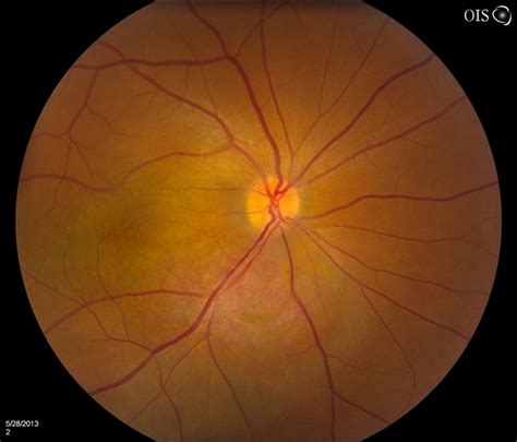 Cavernous Choroidal Hemangioma - Retina Image Bank