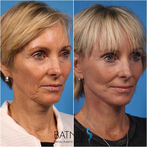 Mini-Facelift Overview: Cost, Recovery, Before After AEDIT, 57% OFF