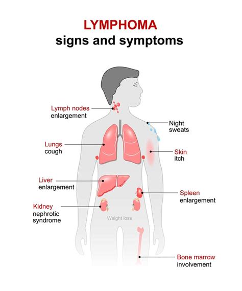 Lymphoma Symptoms - 9 Signs of Hodgkin's & Non-Hodgkin's lymphoma!