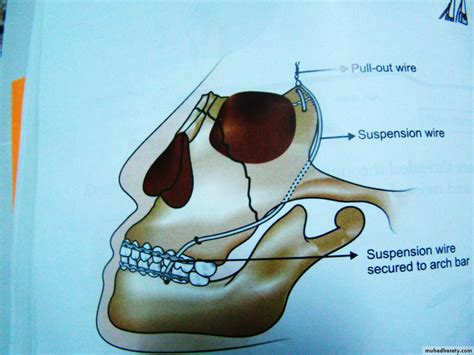 Fracture maxilla pptx - Dr.Wafaa - Muhadharaty