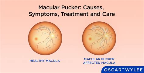 Macular Pucker: Causes, Symptoms, Treatment and Care