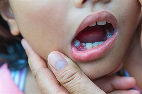 What To Do If Baby Teeth Aren't Falling Out!