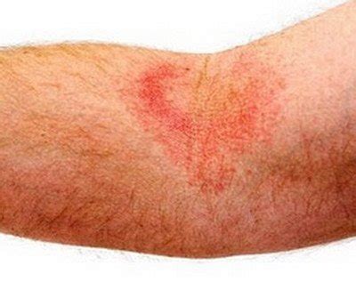 Stills disease, Symptoms (Rash), Causes, Diagnosis, Treatment, Prognosis