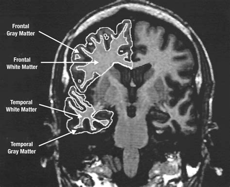 Age-Related Changes in Frontal and Temporal Lobe Volumes in Men ...