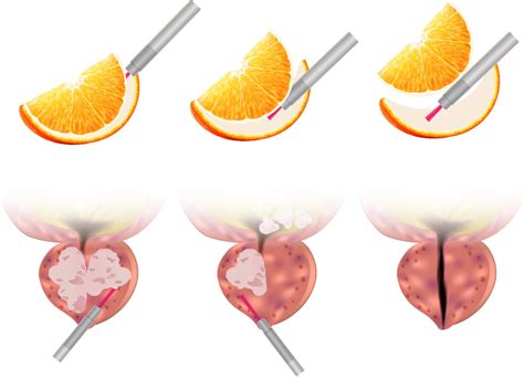 HoLEP Procedure | The Urology Group