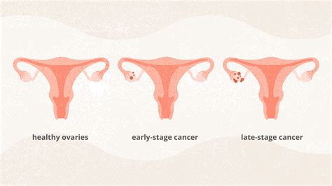 Ovarian Cancer : Symptoms and Treatment To Follow To Cure ...