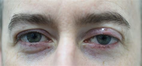 Ocular Rosacea: Causes, Symptoms, Diagnosis and Treatment