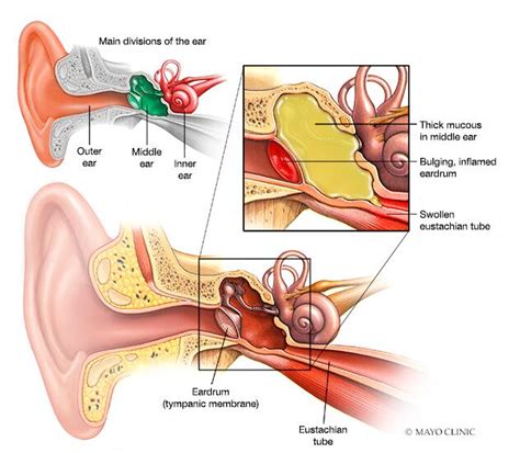 Ear infection (middle ear) - Symptoms & causes - Mayo Clinic