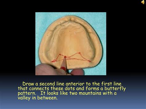 PPT - Posterior Palatal Seal PowerPoint Presentation, free download ...