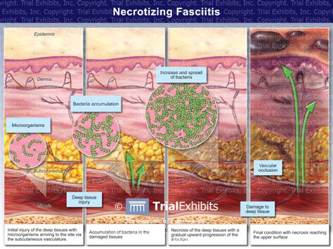 Necrotizing Fasciitis Under A Microscope