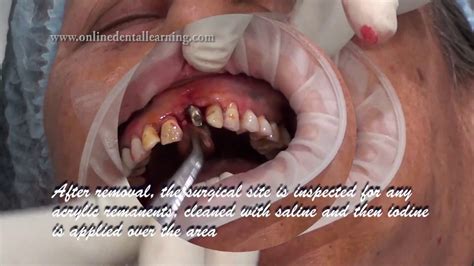 Maxillary Central Incisor Replacement with Implant - YouTube