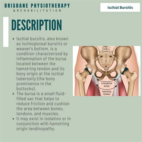 What is Ischial Bursitis? - Brisbane Physiotherapy