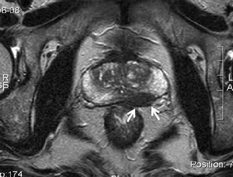 Prostate Lesions On Mri