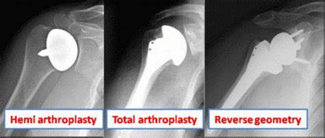 Shoulder Replacement - Pacific Orthopedics and Sports Medicine