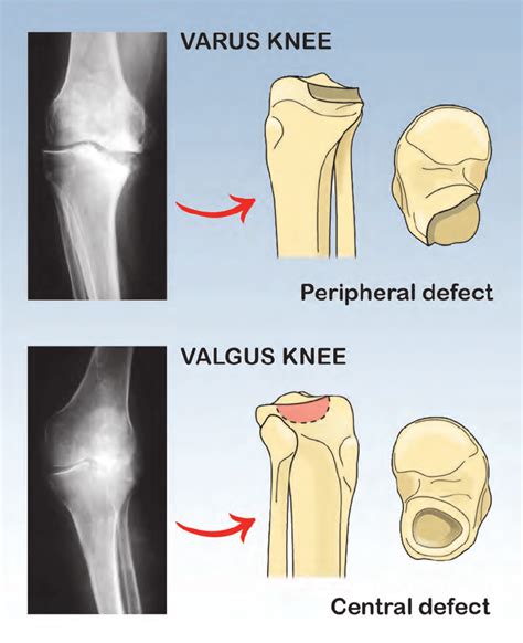 Knee Valgus Vs Varus