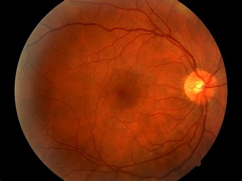 Macular Dystrophy Retina