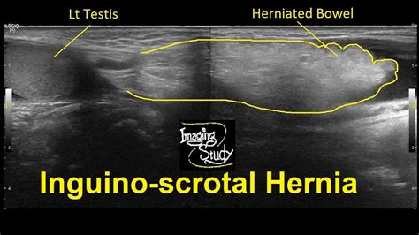 Inguinal Scrotal Hernia Ultrasound | Images and Photos finder