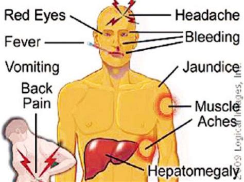 Yellow fever: the disease and the vaccine | by Bessle Pandorine | Medium