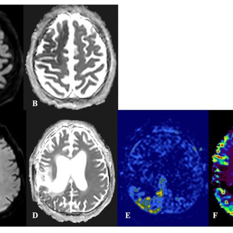 | Diffusion restriction in status epilepticus (SE) and acute ischemic ...