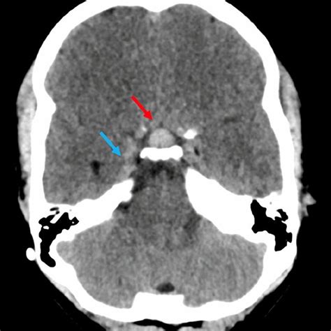 CT scan of the same patient as in Fig. 2. Note the pituitary hyperemia ...