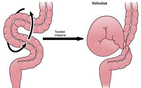 Bowel Obstruction - Small & Large - Causes, Symptoms, Treatment