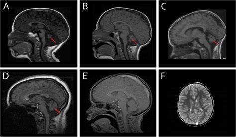 Cerebellar Hypoplasia In Animals