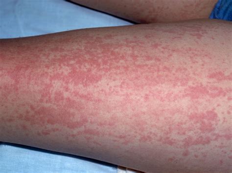 Image IQ: Erythematous rash | Rheumatology Network