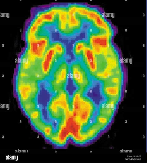 Pet Scan Of Brain Stock Photos & Pet Scan Of Brain Stock Images - Alamy